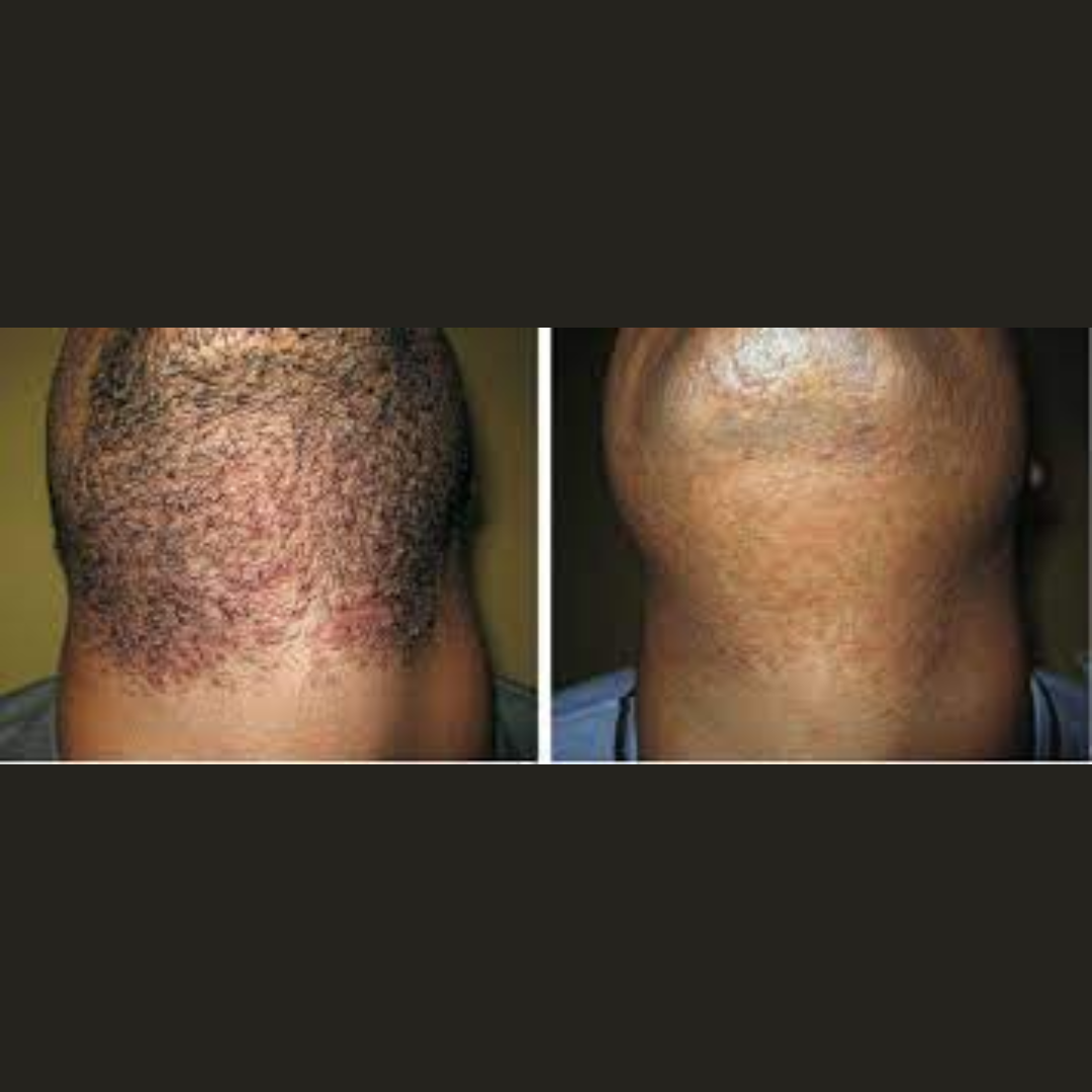 BumpBeGone Ingrown Hair Relief Serum